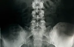 Spine treatment in Raipur